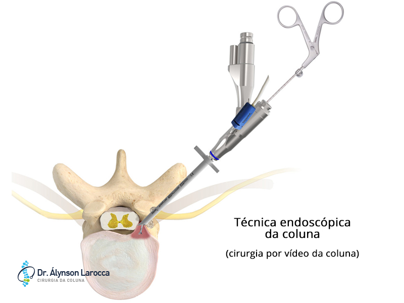 Endoscopia Da Coluna Cirurgia Por V Deo Da Coluna Dr Lynson Larocca
